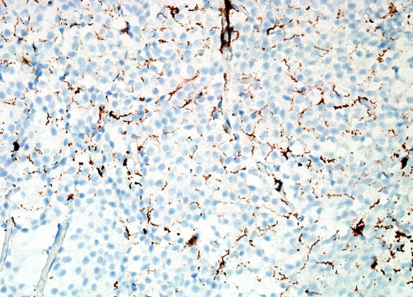 1D Central Neurocytoma (Case 1) NF 1.jpg