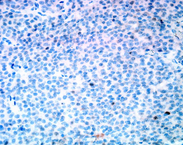 1E Central Neurocytoma (Case 1) NeuN 2.jpg