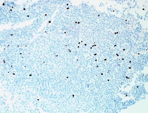 1G Central Neurocytoma (Case 1) Ki67 2.jp