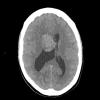 2A1 Central neurocytoma, intraventricular, atypical (Case 2) CT 1 - Copy