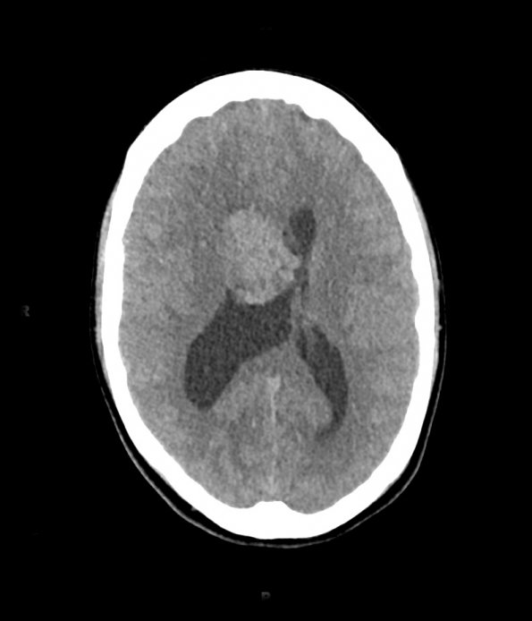 2A1 Central neurocytoma, intraventricular, atypical (Case 2) CT 1 - Copy