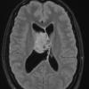 2A2 Central neurocytoma, intraventricular, atypical (Case 2) TIRM 1 - Copy