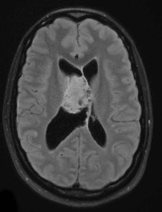 2A2 Central neurocytoma, intraventricular, atypical (Case 2) TIRM 1 - Copy