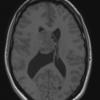 2A3 Central neurocytoma, intraventricular, atypical (Case 2) T1 1 - Copy