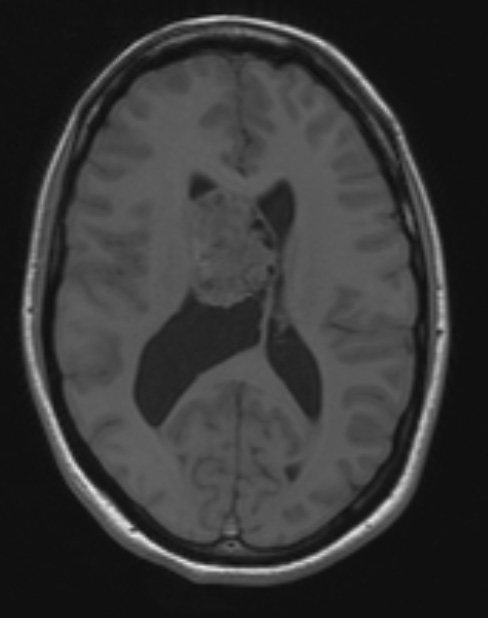 2A3 Central neurocytoma, intraventricular, atypical (Case 2) T1 1 - Copy