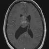 2A4 Central neurocytoma, intraventricular, atypical (Case 2) T1 W 1 - Copy