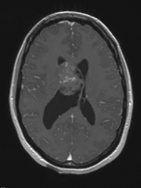 2A4 Central neurocytoma, intraventricular, atypical (Case 2) T1 W 1 - Copy