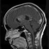 2A5 Central neurocytoma, intraventricular, atypical (Case 23) T1 W 3 - Copy