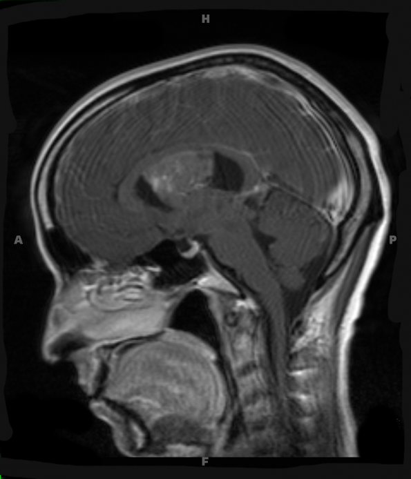 2A5 Central neurocytoma, intraventricular, atypical (Case 23) T1 W 3 - Copy