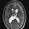 2A6 Central neurocytoma, intraventricular, atypical (Case 2) T2 W 1 - Copy