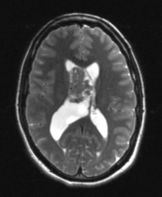 2A6 Central neurocytoma, intraventricular, atypical (Case 2) T2 W 1 - Copy