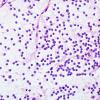 2B1 Central Neurocytoma, intraventricular, atypical (Case 2) smear H&E 2.jpg