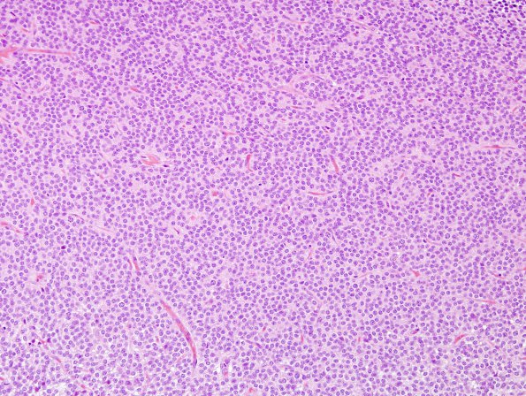 2B2 Central Neurocytoma, intraventricular, atypical (Case 2) H&E 6.jpg