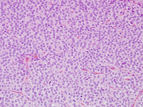 2B3 Central Neurocytoma, intraventricular, atypical (Case 2) H&E2.jpg