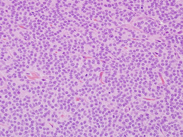 2B4 Central Neurocytoma, intraventricular, atypical (Case 2) H&E1.jpg