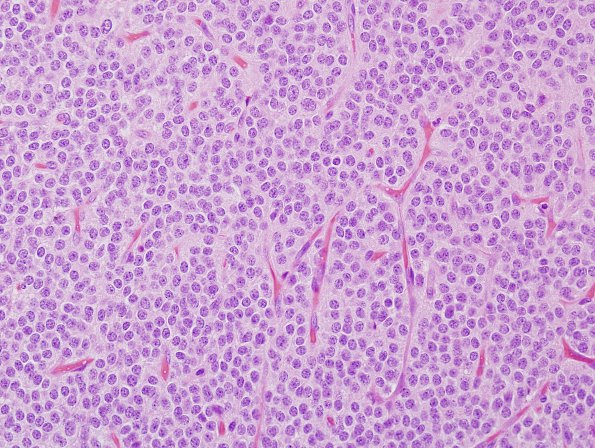 2B5 Central Neurocytoma, intraventricular, atypical (Case 2) H&E4.jpg