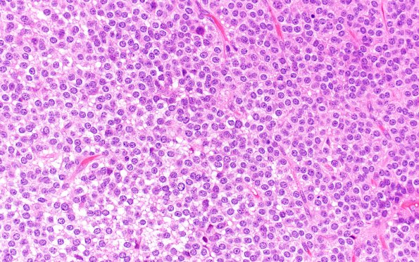 2B6 Central Neurocytoma, intraventricular, atypical (Case 2) H&E4