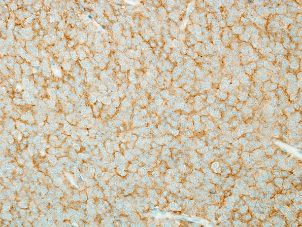 2C1 Central Neurocytoma, intraventricular, atypical (Case 2) SYN 2.jpg