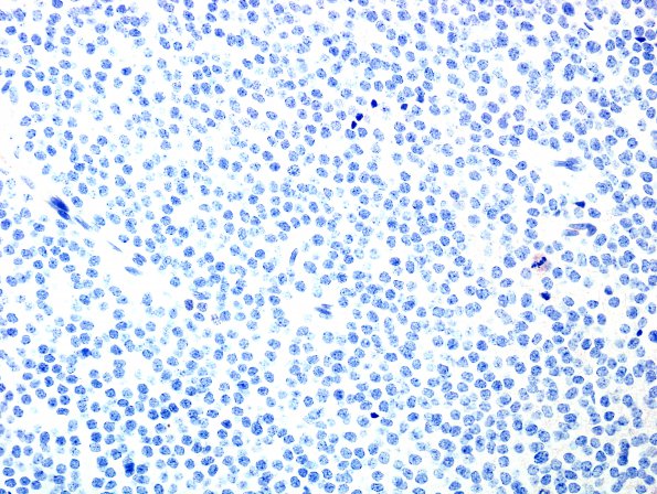 2D Central Neurocytoma, intraventricular, atypical (Case 2) NF 1.jpg