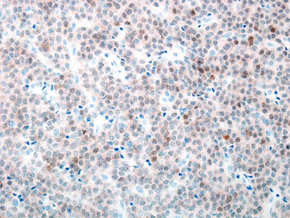 2E Central Neurocytoma, intraventricular, atypical (Case 2) NeuN 2.jpg