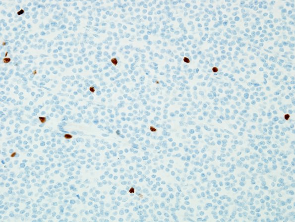 2F Central Neurocytoma, intraventricular, atypical (Case 2) Olig2 1.jpg