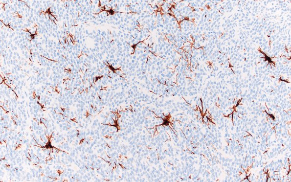 2G Central Neurocytoma, intraventricular, atypical (Case 2) GFAP 2