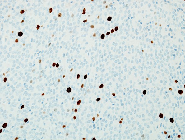 2H Central Neurocytoma, intraventricular, atypical (Case 2) Ki67 2.jpg