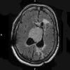 3A1 Neurocytoma, central  (Case 3) T1W A - Copy