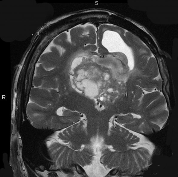 3A3 Neurocytoma, central  (Case 3) MRI 0043A - Copy