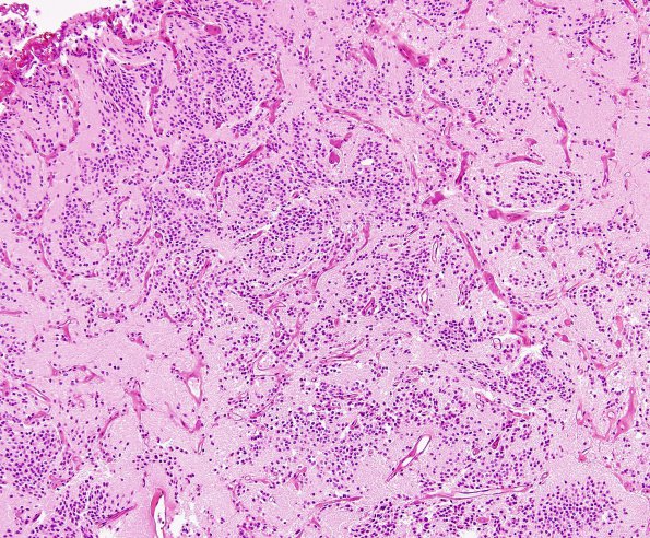 3B1 Neurocytoma, central (Case 3) H&E 1