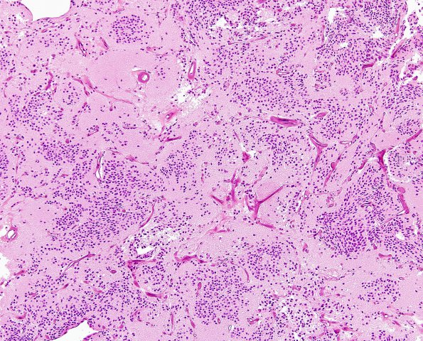 3B2 Neurocytoma, central (Case 3) H&E 4