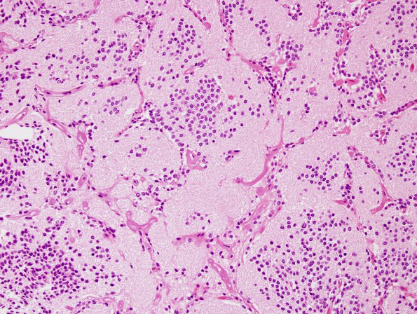 3B3 Neurocytoma, central (Case 3) H&E 6