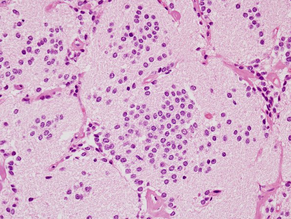 3B4 Neurocytoma, central (Case 3) H&E 7