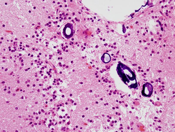 3B5 Neurocytoma, central (Case 3) H&E 8