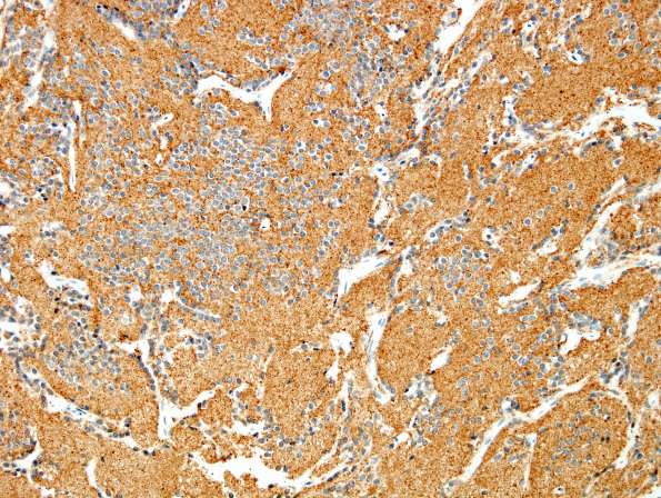 3C1 Neurocytoma, central (Case 3) SYN 5