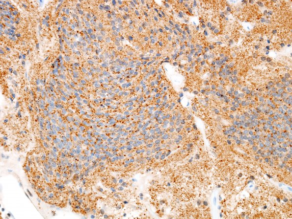 3C2 Neurocytoma, central (Case 3) SYN 4