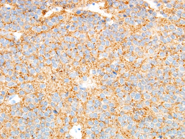 3C3 Neurocytoma, central (Case 3) SYN 11