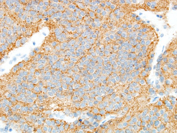 3C4 Neurocytoma, central (Case 3) SYN 10