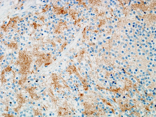 3D3 Neurocytoma, central (Case 3) Chromogranin 1