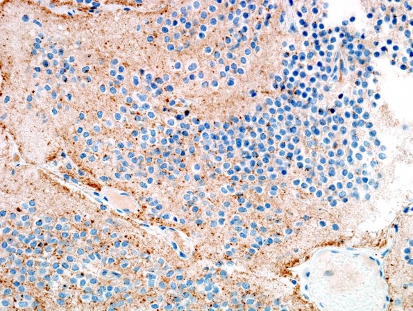 3D4 Neurocytoma, central (Case 3) Chromogranin 3