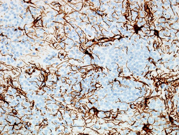 3E1 Neurocytoma, central (Case 3) GFAP 3