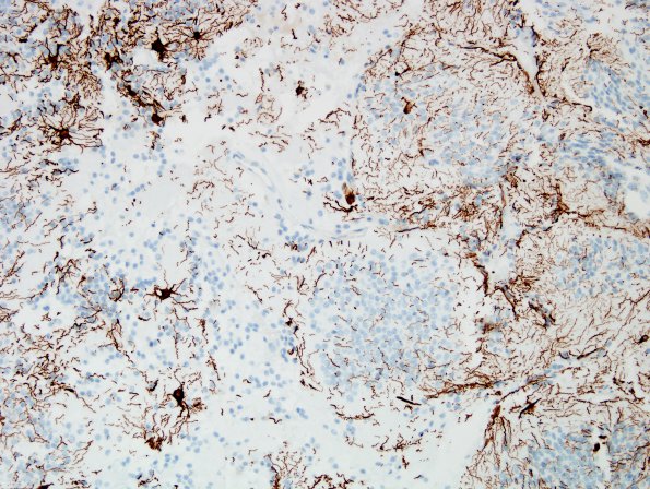 3E2 Neurocytoma, central (Case 3) GFAP 8