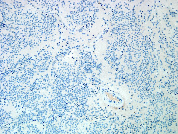 3F1 Neurocytoma, central (Case 3) IDH1 2