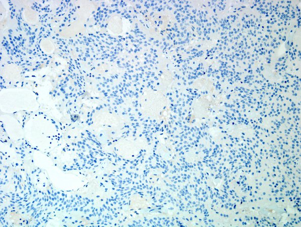 3F2 Neurocytoma, central (Case 3) CD99 3