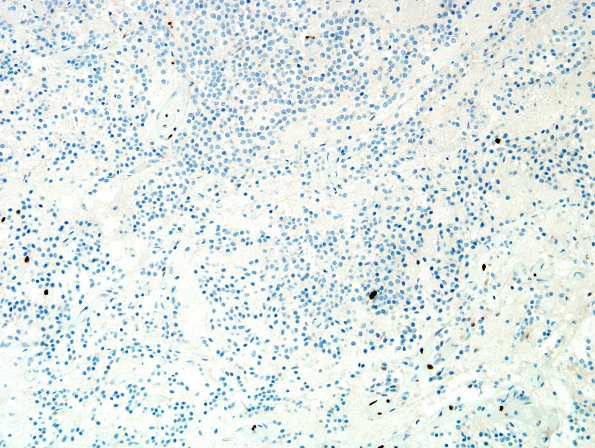 3F3 Neurocytoma, central (Case 3) MIB-1