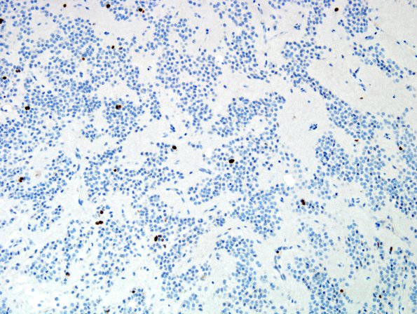 3F4 Neurocytoma, central (Case 3) MIB 1