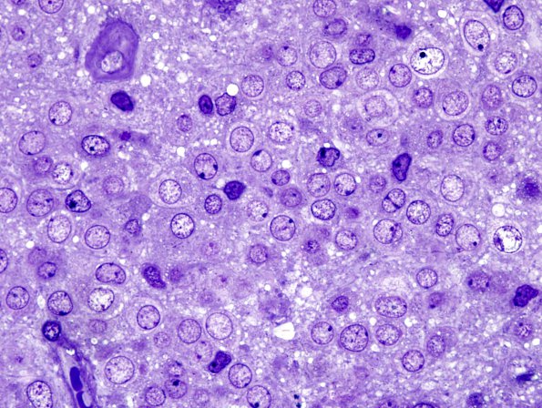 3G1 Neurocytoma, central (Case 3) Plastic 1