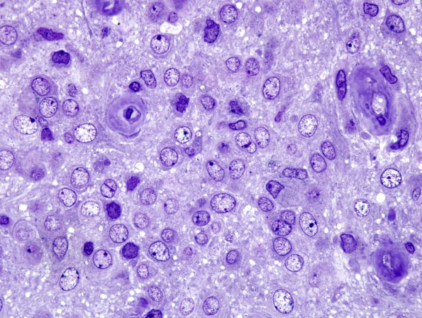 3G2 Neurocytoma, central (Case 3) Plastic 4