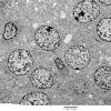 3H1 Neurocytoma, central (Case 3) EM 1 - Copy