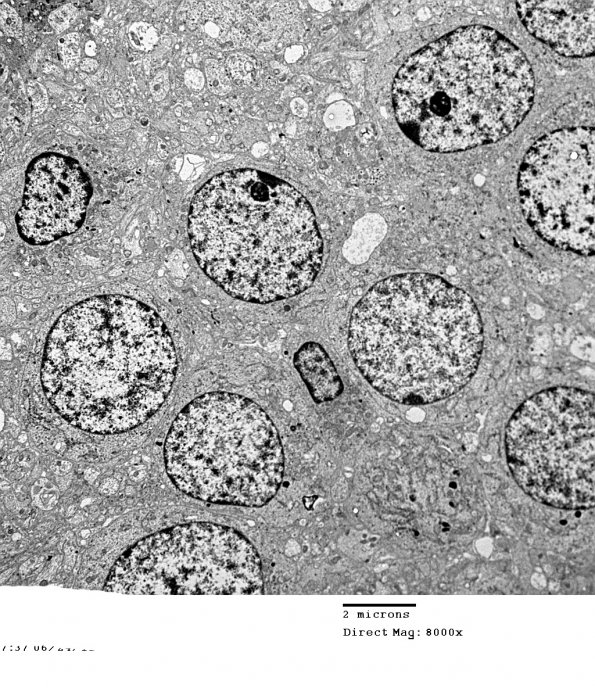 3H1 Neurocytoma, central (Case 3) EM 1 - Copy